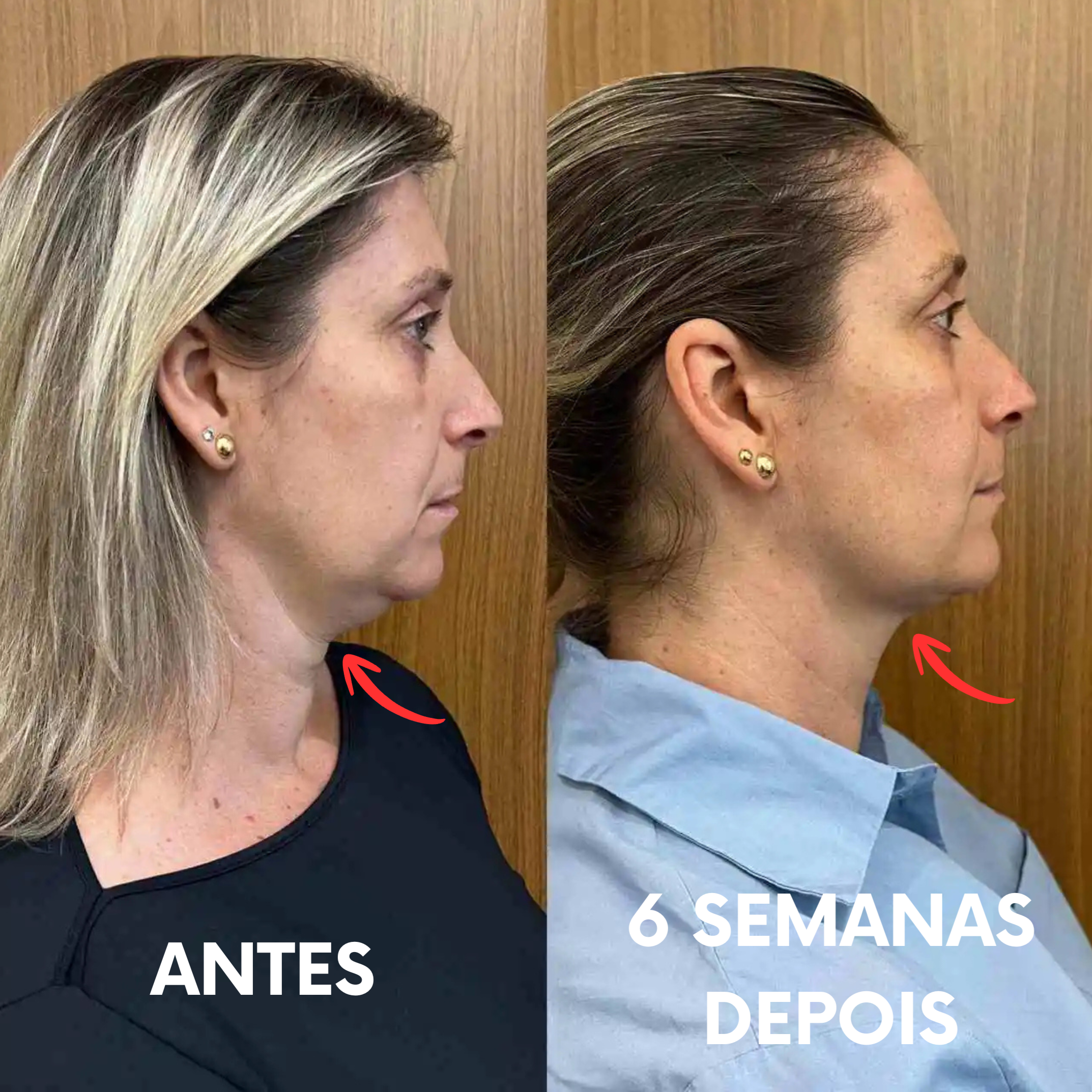 Escova de Drenagem Linfática